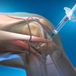 Injected knee to relieve osteoarthritis pain