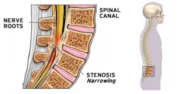 spinal stenosis treatments Xcell Medical Elyria