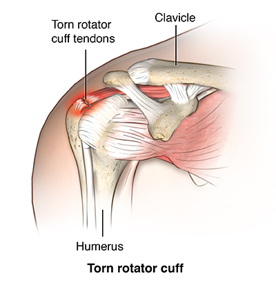 Anterior view of shoulder comparing normal rotator cuff tendons to torn rotator cuff; AMuscsk_20140310_v0_010;
