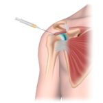 diagram of a shoulder joint injection