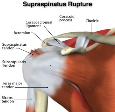 supraspinatus tendon tear diagram