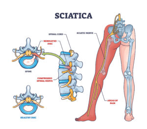 Sciatica